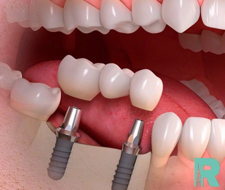 Учеными придумана альтернатива зубным имплантам