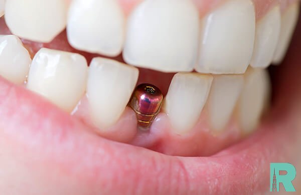 Ученые России заявляют об опасности зубных имплантатов